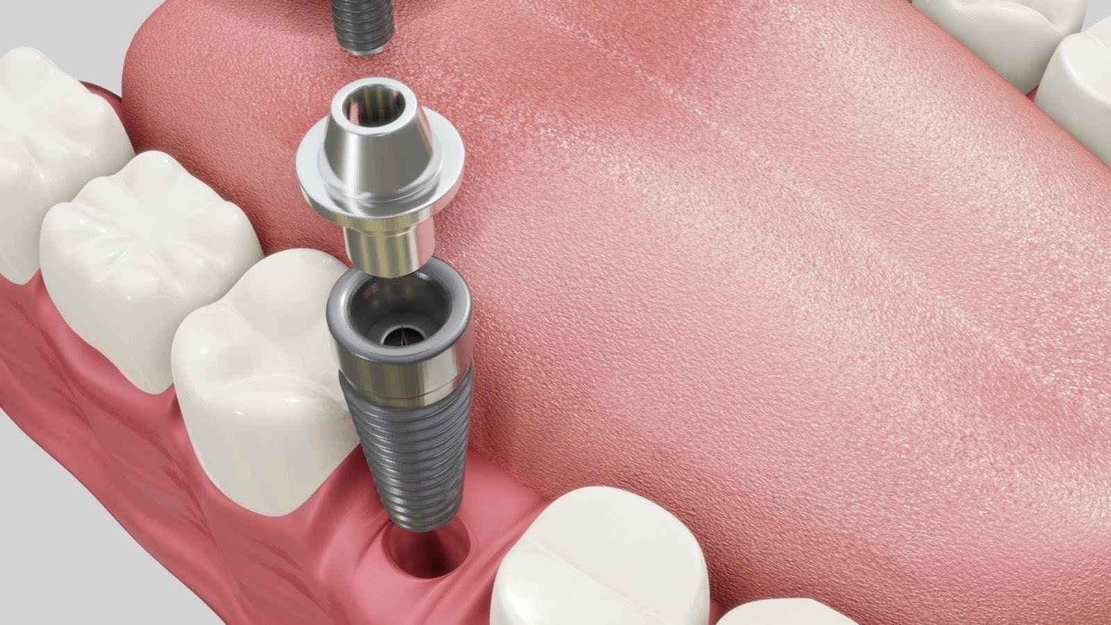 Cutaway illustration of a dental implant — the titanium fixture in the jawbone, the abutment above it, and the crown that attaches on top
